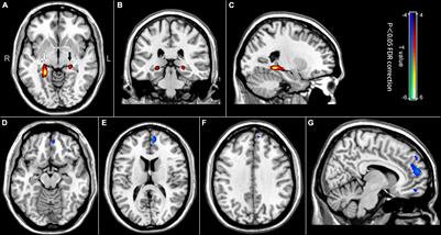 Altered Regional Brain Glucose Metabolism in Diffuse Large B-Cell Lymphoma Patients Treated With Cyclophosphamide, Epirubicin, Vincristine, and Prednisone: An Fluorodeoxyglucose Positron Emission Tomography Study of 205 Cases